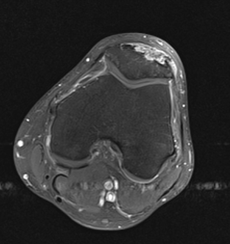 Figure 6 for case gout arthritis ( RID3567 )